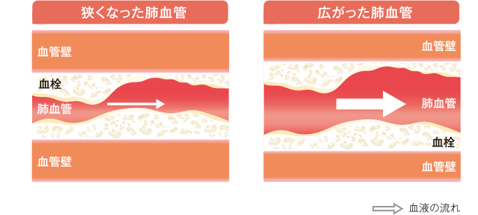 CTEPHの肺血管（イメージ）