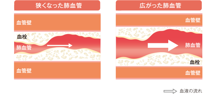 CTEPHの肺血管(イメージ)