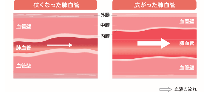 PAHの肺血管(イメージ)