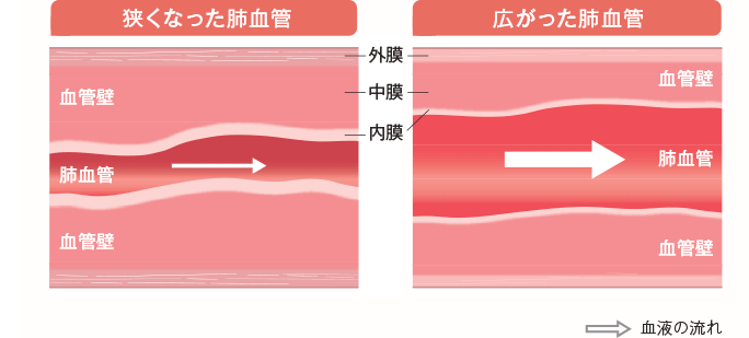 PAHの肺血管（イメージ）