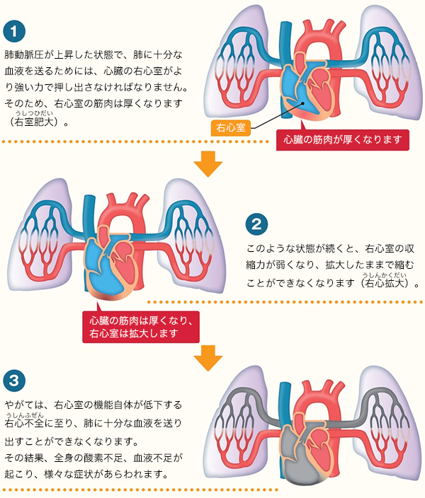 肺高血圧症が進行すると、肺だけでなく、心臓にも影響を及ぼすようになります。